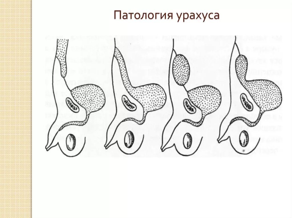 Аномалия мочевого. Аномалия мочевого протока урахуса. Пороки развития урахуса.