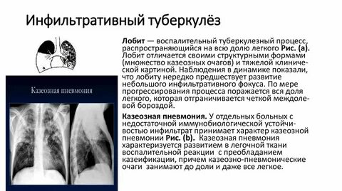 Очаговый и инфильтративный туберкулез
