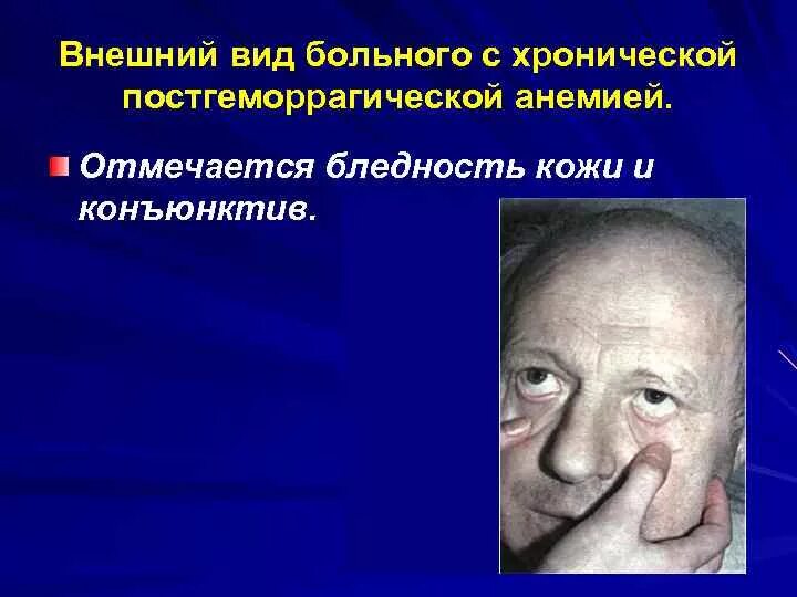 Больные малокровием. Хроническая постгеморрагическая анемия. Патогенез хронической постгеморрагической анемии.