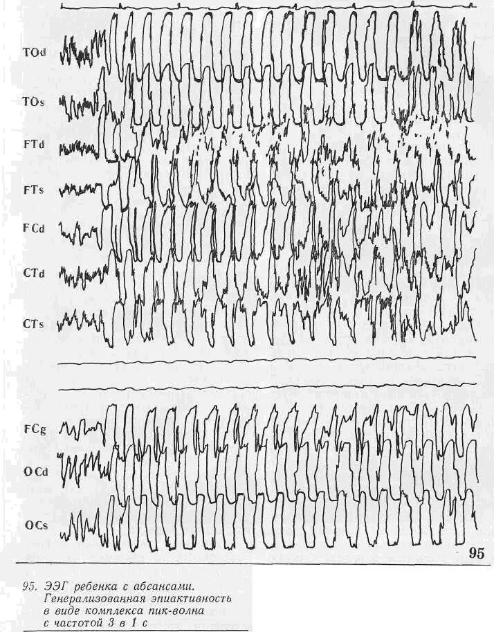 Спайк комплексы на ээг. Роландическая эпилепсия ээг. Эпилептиформная активность на ээг. Как выглядит эпиактивность на ээг у ребенка. Эпиактивность это.