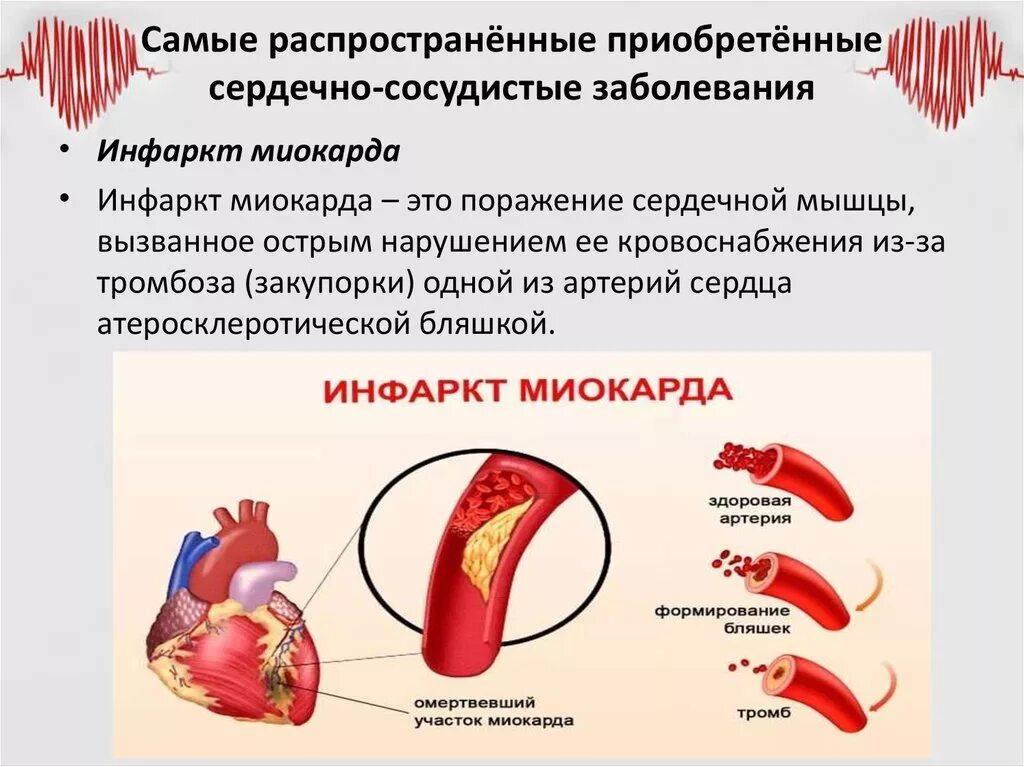 Сердечно-сосудистые заболевания. Заболевания сирдечнососудистой системы. Распространенные болезни сердца.