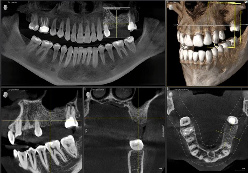 Где сделать кт зуба. 3д конусно-лучевая компьютерная томография. Компьютерная томография (1 челюсть) это что. Кт челюсти (конусно-лучевая компьютерная томография).