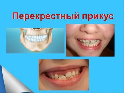Зубы сбоку