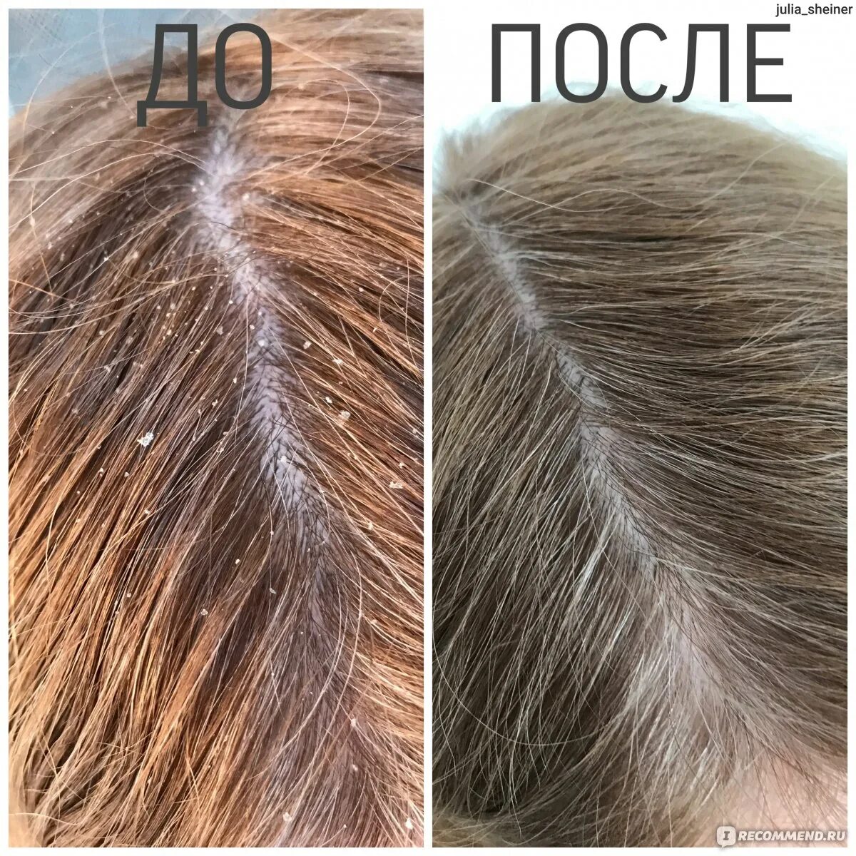 Перхоть после кератина. Перхоть после кератина. Шампуни при кератиновом выпрямлении волос. Пилинг кожи головы до и после. Асбестовидный себорейный дерматит.