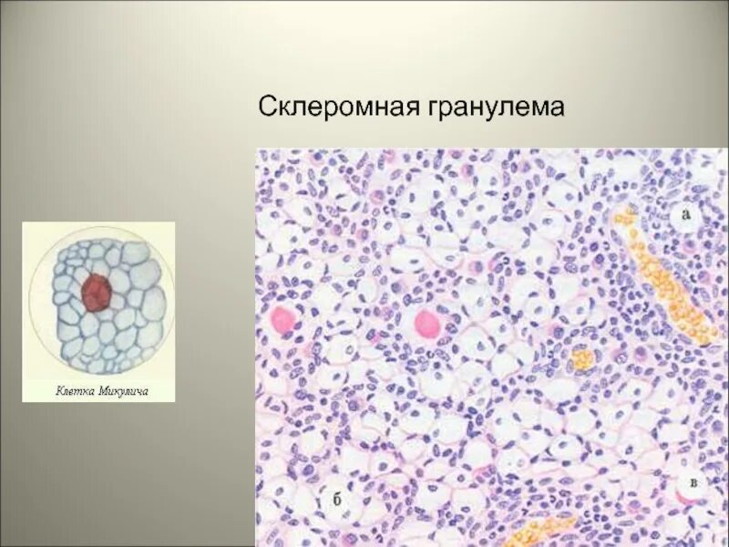 Эпителиоидно клеточная гранулема. Эпителиоидноклеточные гранулемы. Клеточных состав туберкулезного гранулемы. Клеточный состав гранулемы. Клеточная гранулема.