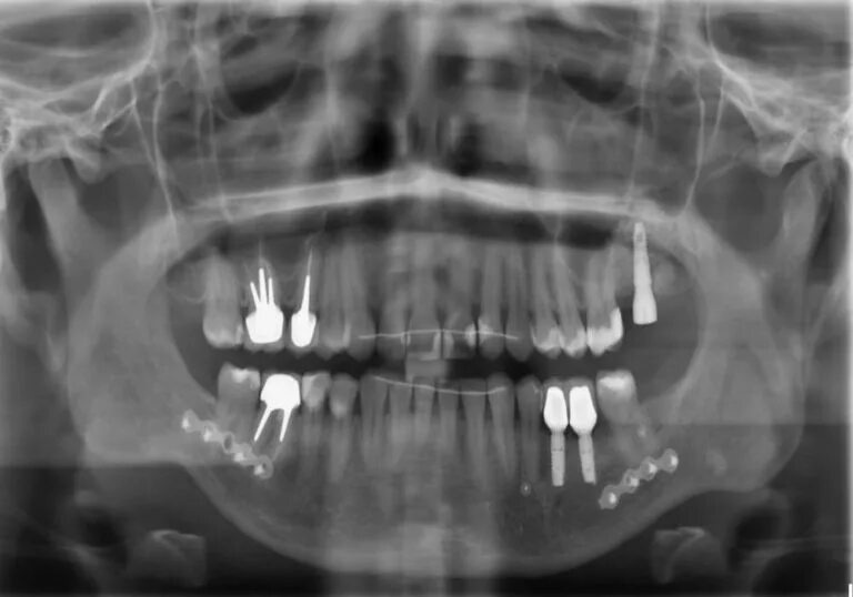 рентген с брекетами можно