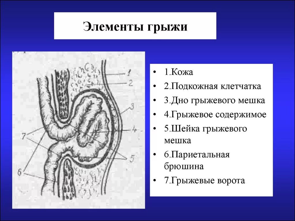 Стенка грыжевого мешка. Составные части наружной грыжи живота. строение грыжи брюшной стенки. строение стенки грыжевого мешка. грыжевой мешок строение.