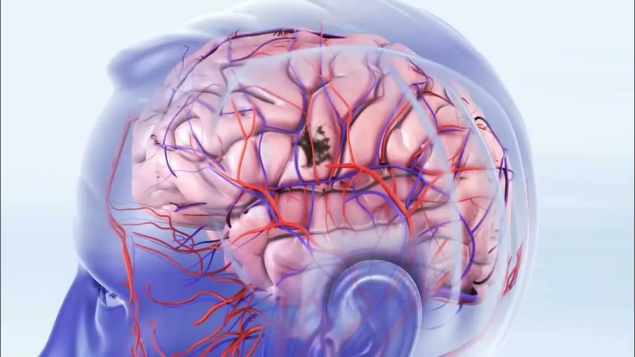 Заболевание сосудов мозга. Аритмия головного мозга.