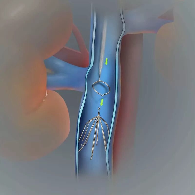 Нижняя полая Вена с кава фильтром. Кава фильтр имплантируется в. Илеофеморальный венозный тромбоз. Кава фильтр в нижнюю полую Вену. Тромбоз почечной вены