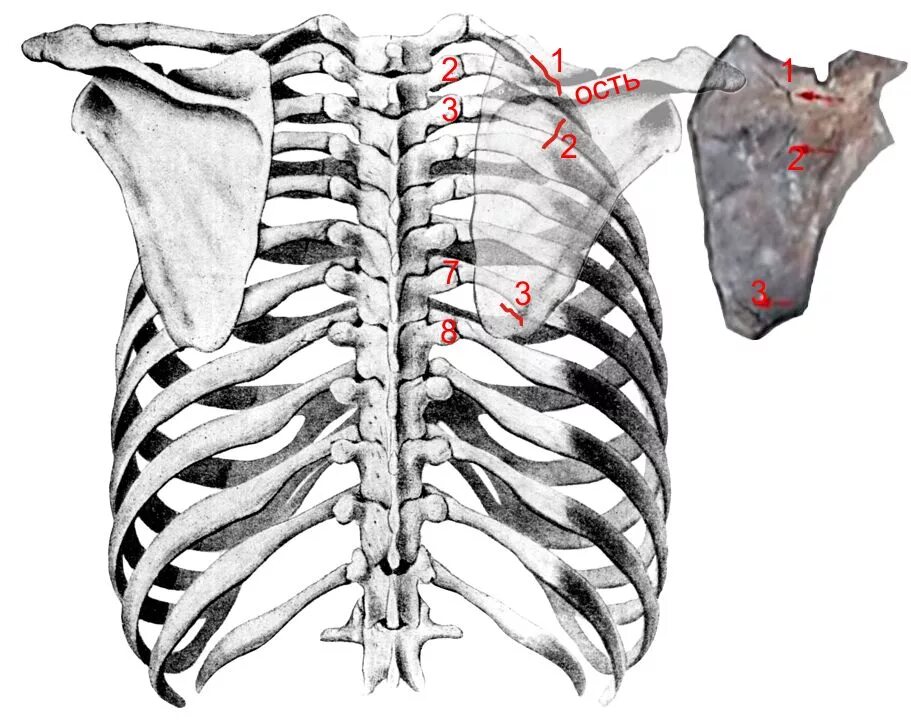 перелом ребра со спины