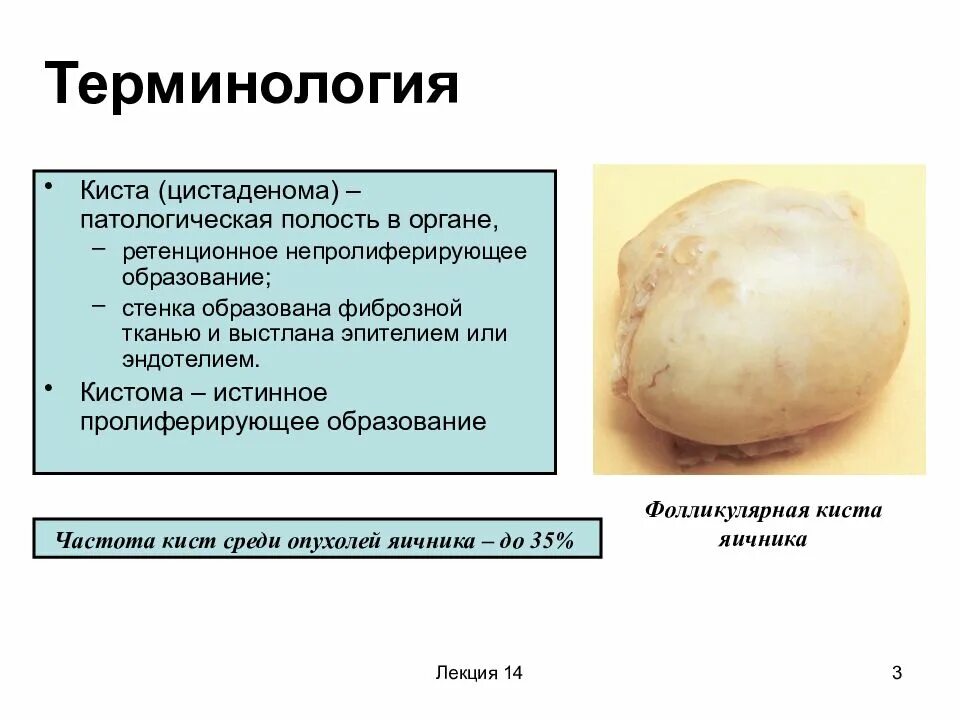 Какая норма кисты. Кисты и опухоли яичников. Цистаденома яичника фолликулярная.