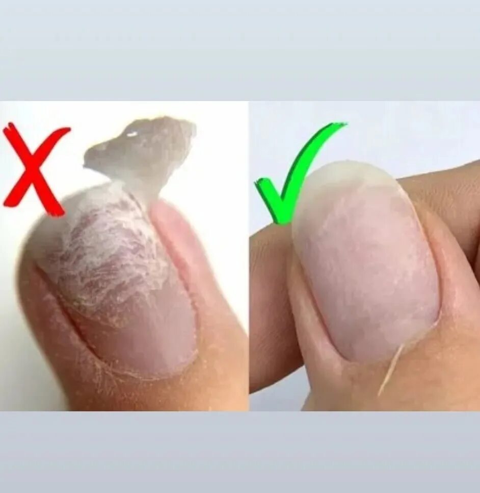 Почему отваливаются ногти гель. Содранное покрытие с ногтей. Снятие гель лака. Ногти после снятия гель лака фрезой.