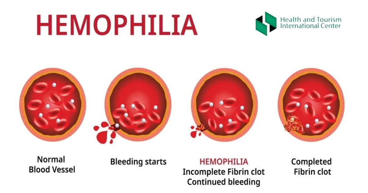 Заболевание крови гемофилия