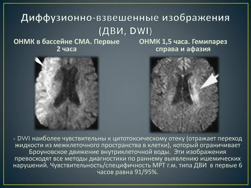 Диффузионно-взвешенное изображение. Диффузно взвешенное изображение. Ограничение диффузии на мрт. Диффузионно взвешенное изображение мрт.