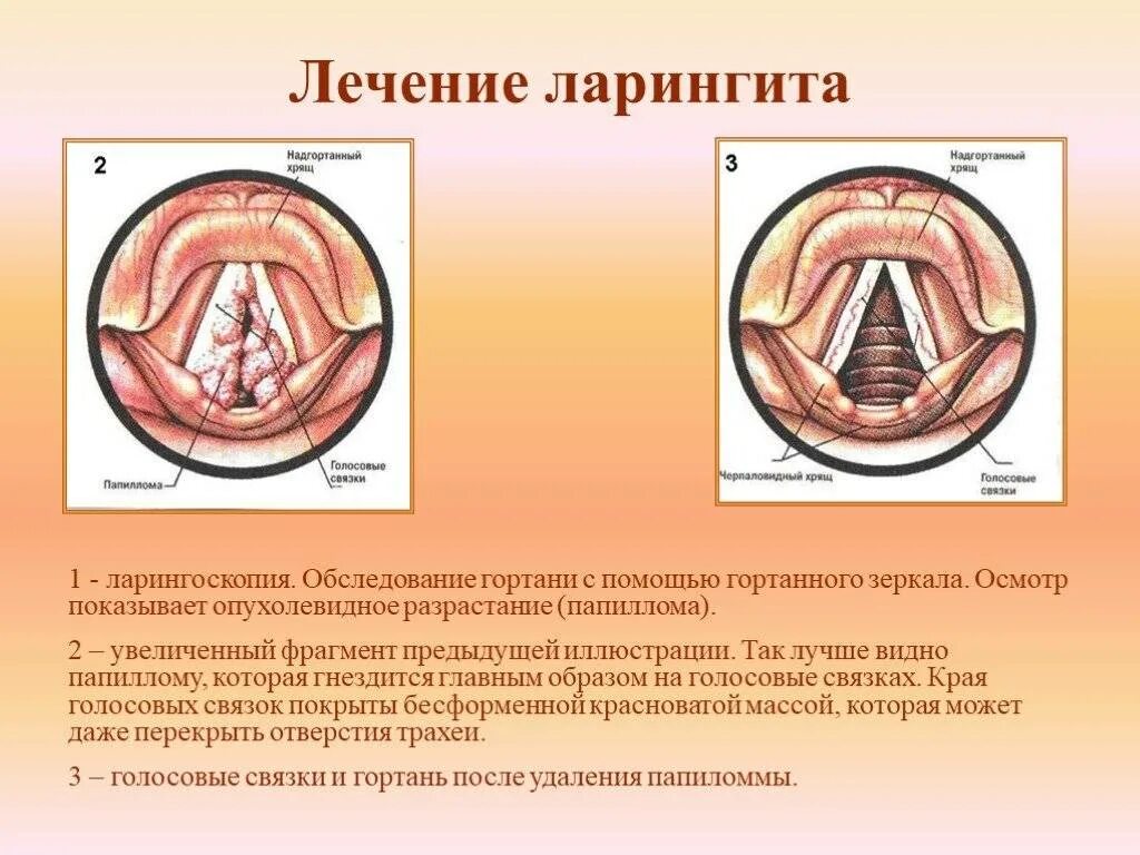 Лечение голосовых связок. Флегмонозный ларингит. Острый и хронический ларингит симптомы. Подскладочный ларингит. Острый инфильтративный ларингит.