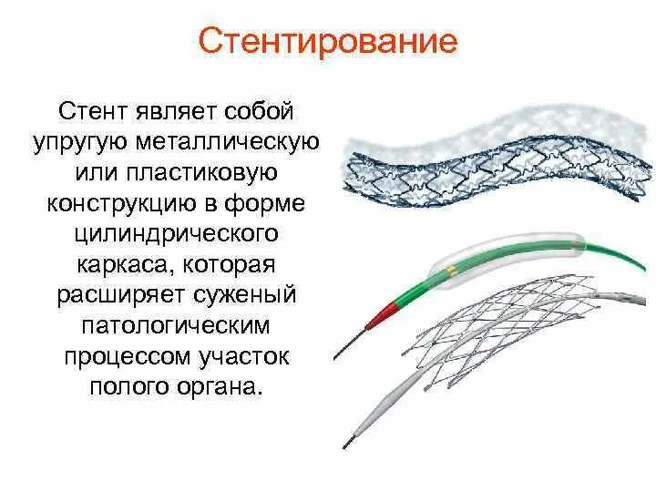 Стенты отзывы