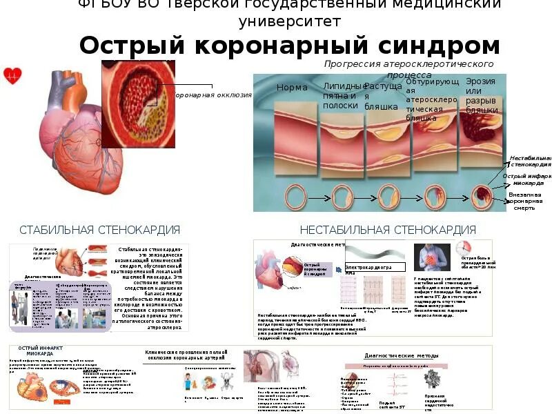 Осложнения острого коронарного синдрома. Острый коронарный синдр. Острый коронарный синдром. Острый коронарный синдром (окс). Острый коронарный синдром без подъема сегмента st патогенез.