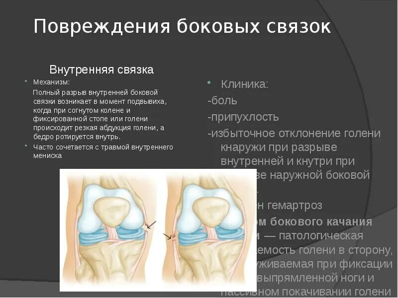 Застарелые повреждения суставов. Перерастяжение связок коленного сустава. Разрыв боковых связок коленного сустава мкб. Травма боковой связки колена. Разрыв боковой связки коленного.