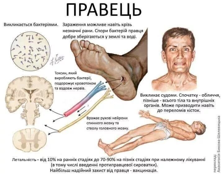 Сколько развивается столбняк. Сколько развивается столбняк
