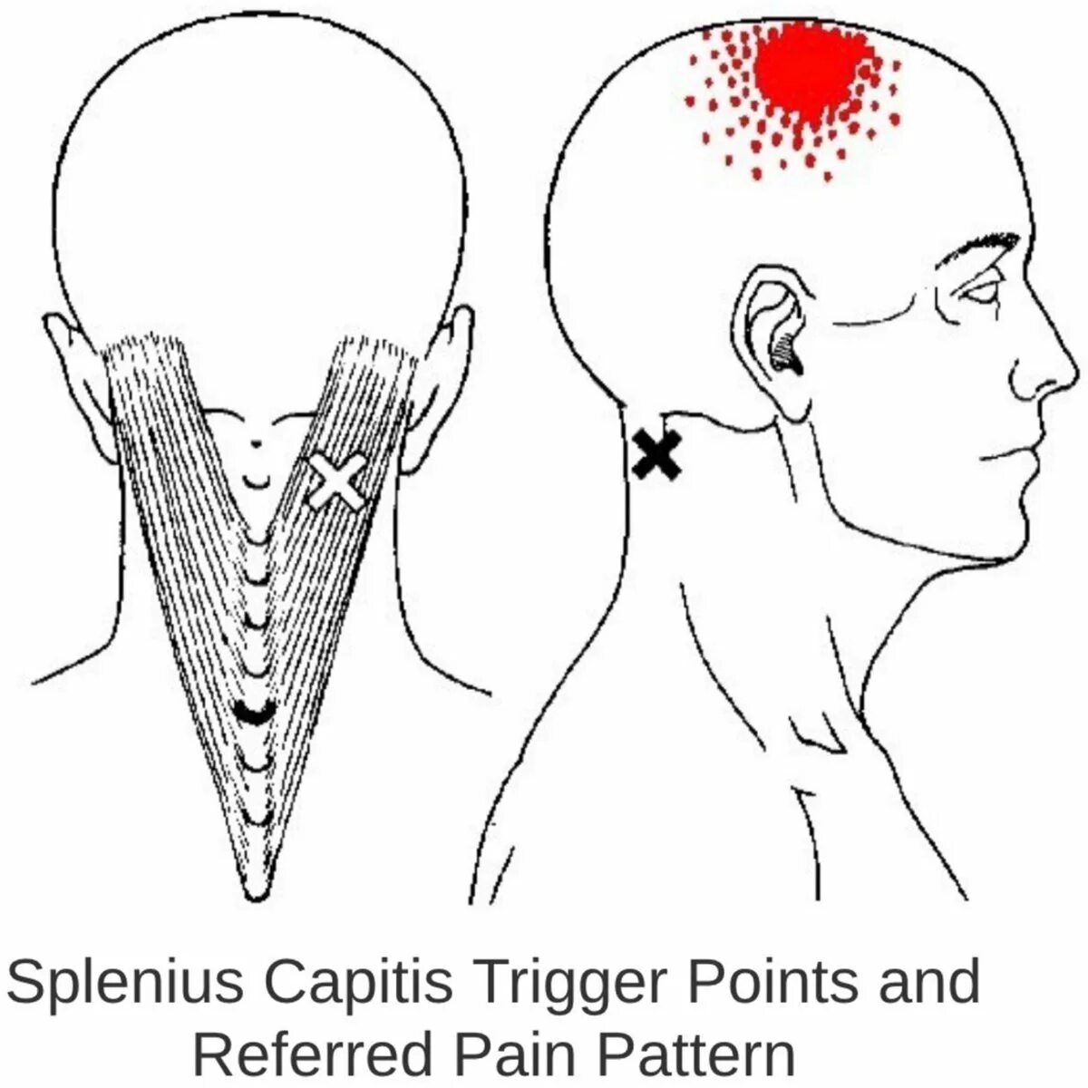 Затылок пульсирует и болит. Ременная мышца шеи триггерные точки. Триггерные точки мышц шеи. Мышцы шеи и лица триггерные точки. Мышцы шеи триггерные точки схема.