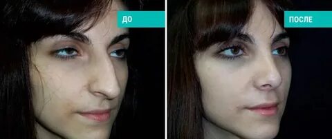 Текст песни ринопластика kai