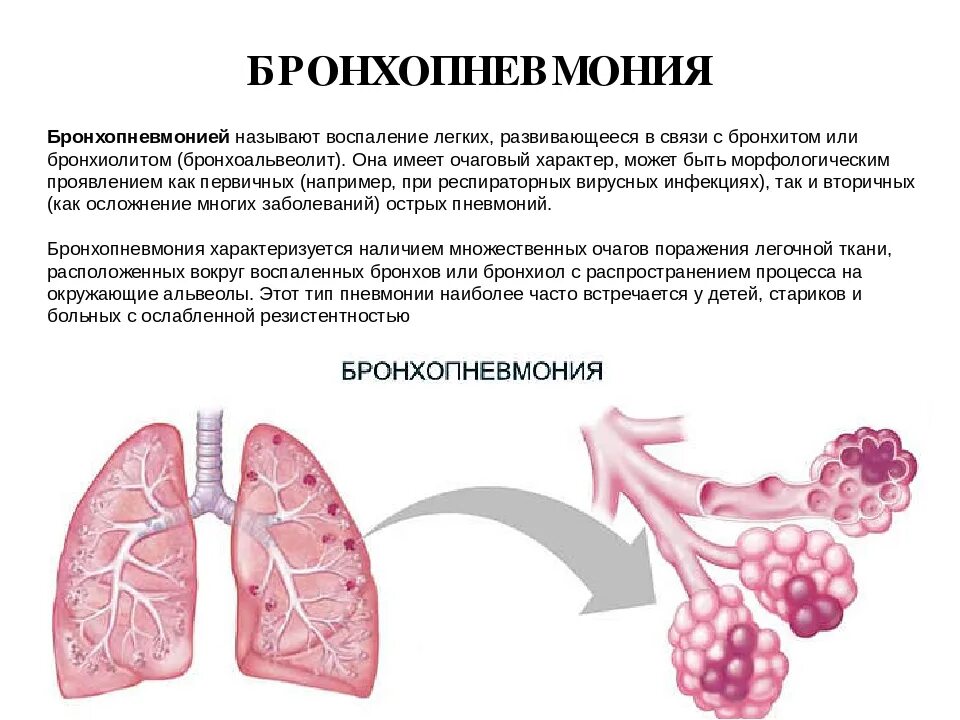 Лечение легкого ковида. Бронхиальная пневмония. Очаговая бронхиальная пневмония. Крупозная пневмония и бронхопневмония. Гипостатическая бронхопневмония.