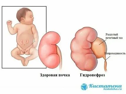 Почки у ребенка в 2 года