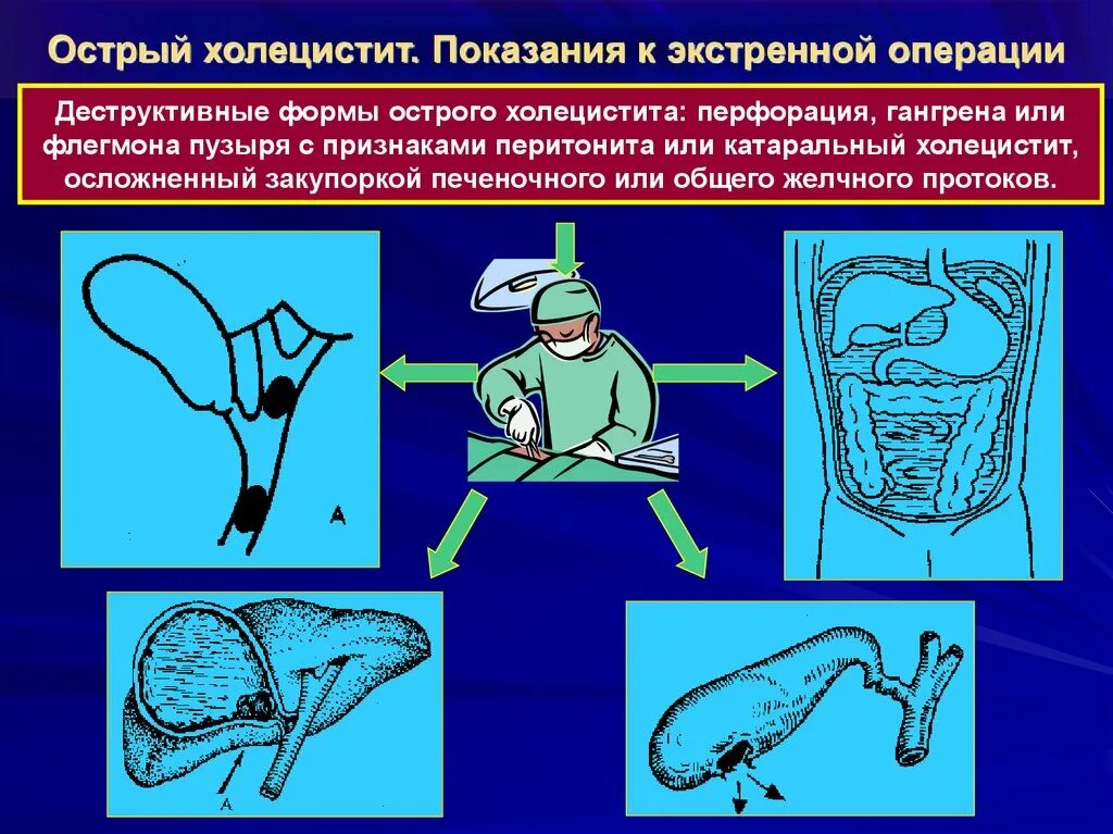 Острый холецистит хирургические. Острый холецистит хирургические болезни лекция. Острый деструктивный холецистит. Острый холецистит показания к операции. Острый холецистит экстренная операция.