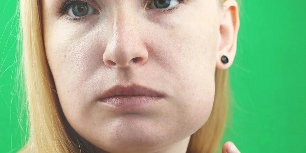 Лимфоузел под челюстью зуб. Припухлость на подбородке. отек под нижней челюстью. отек нижней части лица.