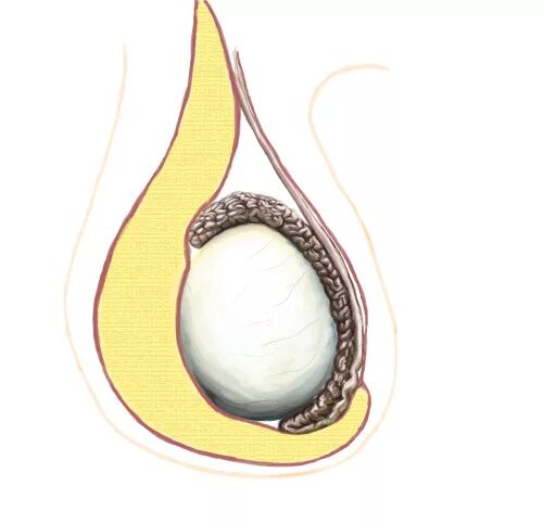 Гидроцеле осумкованное. Водянка яичка гидроцеле. Операция при гидроцеле Винкельмана. Водянка яичка операция Винкельмана. Плотное яичко