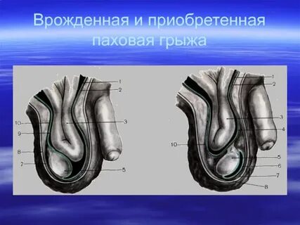 Паховая грыжа у новорожденных мальчиков