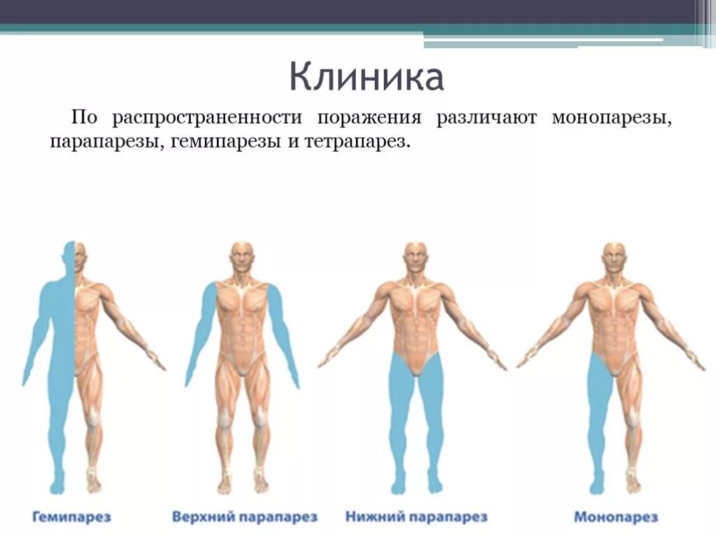 Гемипарез и гемиплегия синдромы. Виды порезов и пораличей. Виды парезов. Правый гемипарез