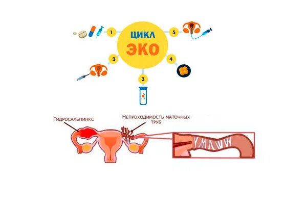 Гидросальпинкс эпидемиология. Гидросальпинкс на УЗИ. Удалили трубу можно ли забеременеть