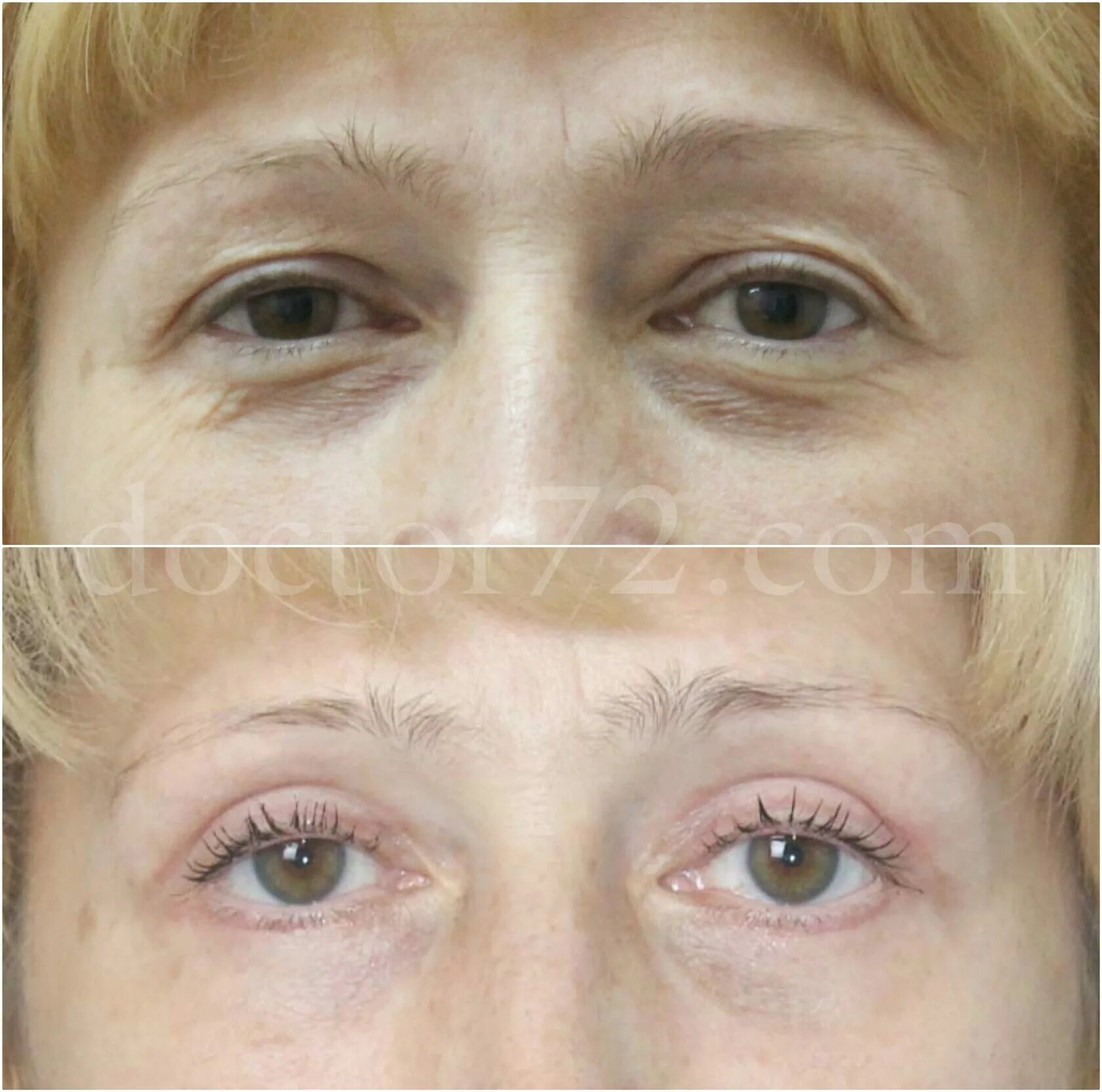 чек лифтинг средней зоны лица. тремба ирина анатольевна блефаропластика. пластическая хирургия уфа отзывы. блефаропластика егорова мария. блефаропластика со2 кандела.