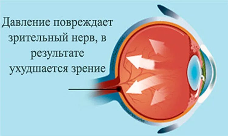 Как снизить глазное давление быстро. Повышенное внутриглазное давление симптомы. глазное давление симптомы у взрослых. давление глазного яблока. повышенное давление глазного дна.