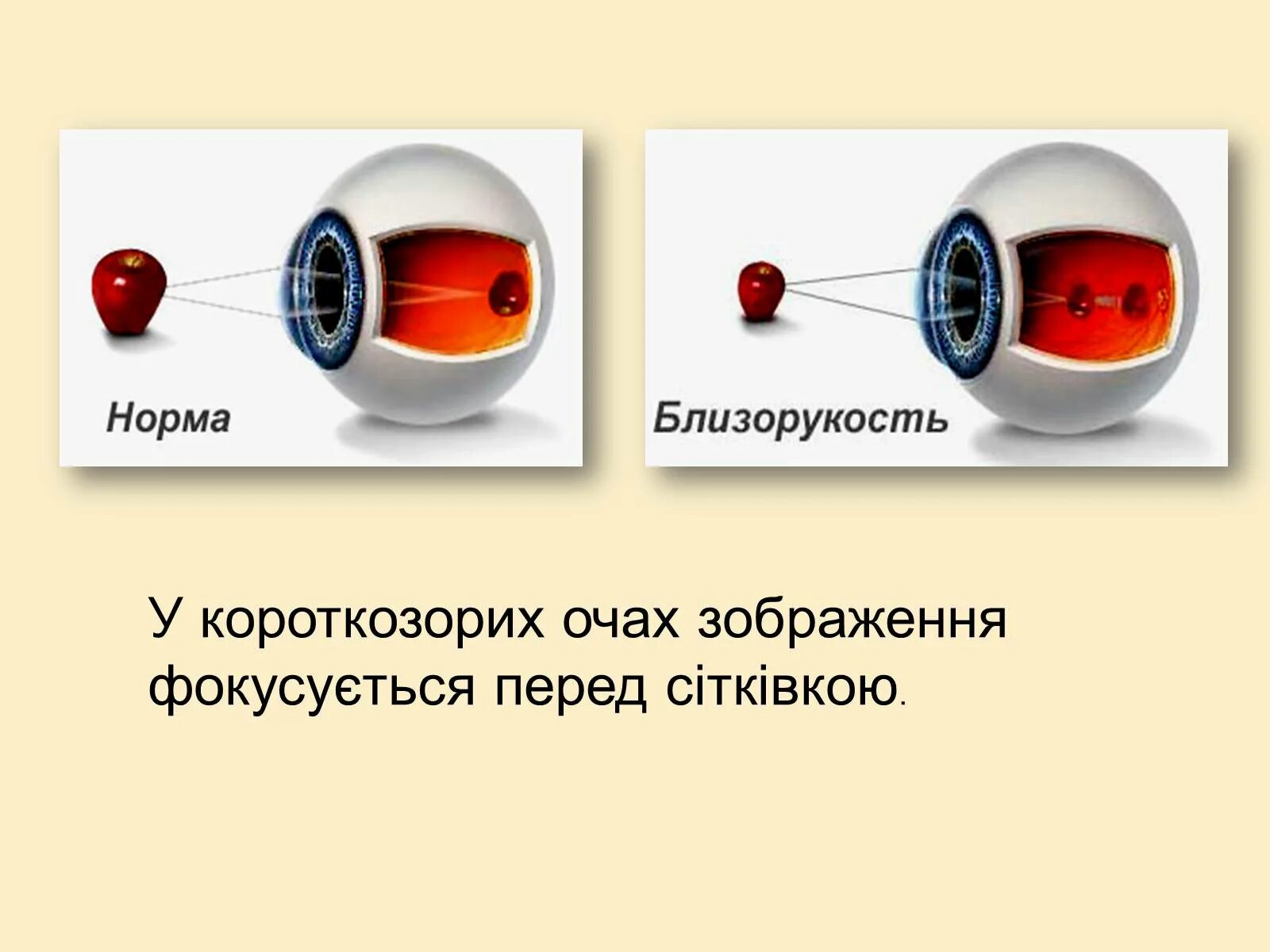 У близоруких людей изображение фокусируется перед сетчаткой. Изображение перед сетчаткой. Изображение фокусируется перед сетчаткой. Близорукость перед сетчаткой. Изображение предметов фокусирующихся перед сетчаткой это.