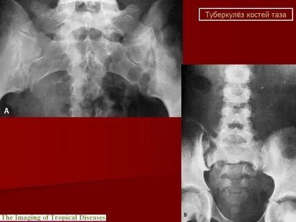 Туберкулез костно суставной системы
