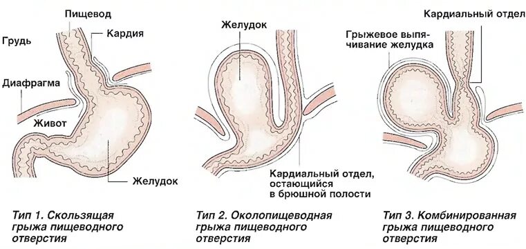 Пищеводная грыжа пищеводного отверстия. Пищеводная грыжа пищеводного отверстия диафрагмы. Фундальная грыжа пищеводного отверстия диафрагмы. Параэзофагеальные грыжи диафрагмы. Несмыкание кардии желудка