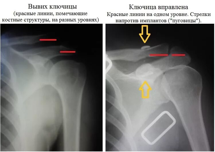 Акромиальная ключица