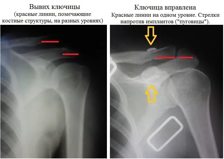 Вывих акс плечевого сустава рентген. Вывих акромиально-ключичного сочленения. Акромиальный конец ключицы рентген. Вывих акромиально-ключичного сочленения рентген. Разрыв плечевого сустава симптомы