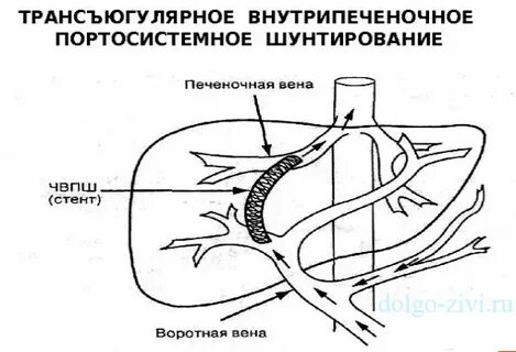 Синдром шунтирования печени