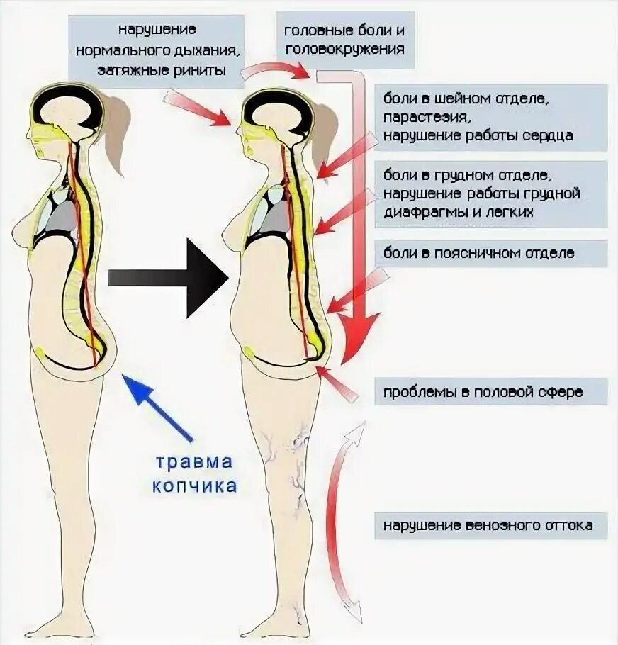 Онемение копчика. Онемение копчика. Сильные боли в крестцовом отделе. Болит спина. Эпителий копчиковый ход.