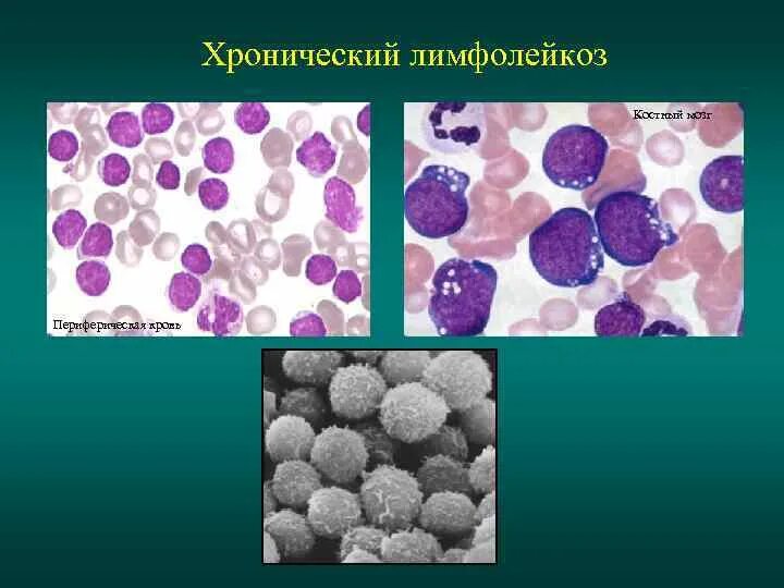 Тени Боткина Гумпрехта. Тени Боткина-Гумпрехта при хроническом лимфолейкозе это. Клетки Боткина Гумпрехта это. Острый лимфобластный лейкоз тени Боткина Гумпрехта. B хронический лимфолейкоз