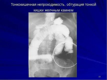 Как понять непроходимость кишечника