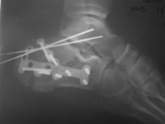 Операции при переломах пяточной кости. Перелом пяточной кости без смещения рентген. Остеосинтез лодыжки рентген. Клювовидный перелом пяточной кости. Остеопороз пяточной кости рентген.