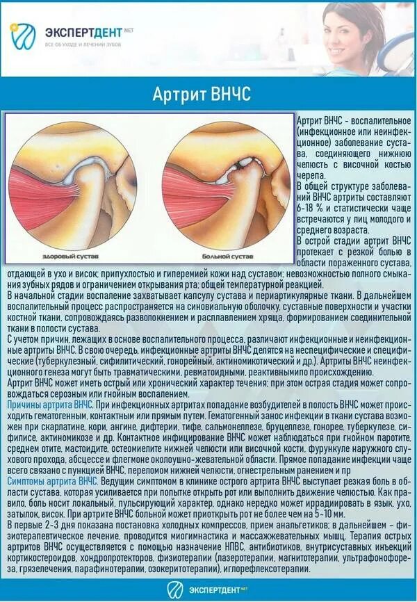 Лечение челюстного артрита. Артрит височно-нижнечелюстного сустава симптомы. Артрит, артроз, дисфункция височно-челюстного сустава. Острый височно нижнечелюстной артрит.