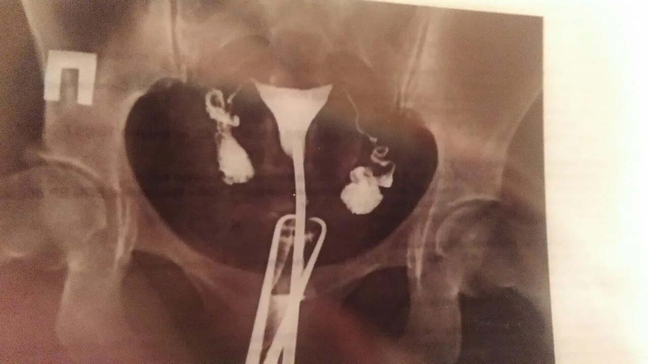 Полип матки гистеросальпингография. Гистеросальпингография что это такое в гинекологии. Сактосальпинкс что это такое. Сактосальпинкс маточных труб. Гидросальпинкс на узи.