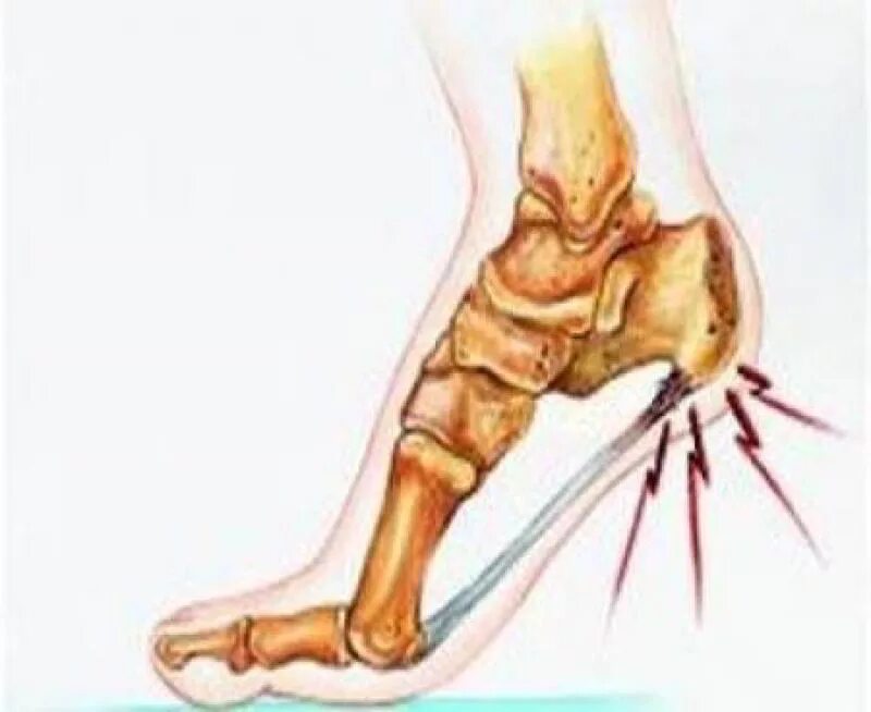 Болит пятка больно наступать после сидения