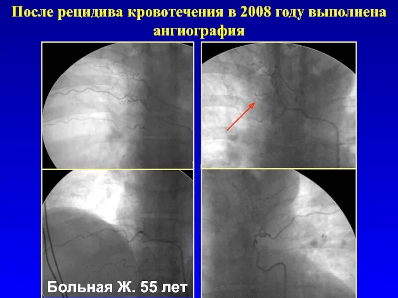 Легочное кровотечение хирургия. Рецидивирующее легочное кровотечение. Эмболизация бронхиальных артерий. Эмболизация бронхиальных артерий при кровохарканье.