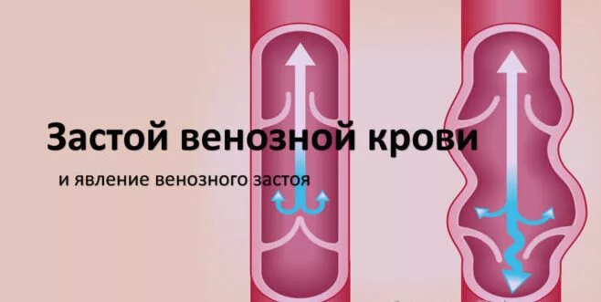 Застой вен. Застой вен